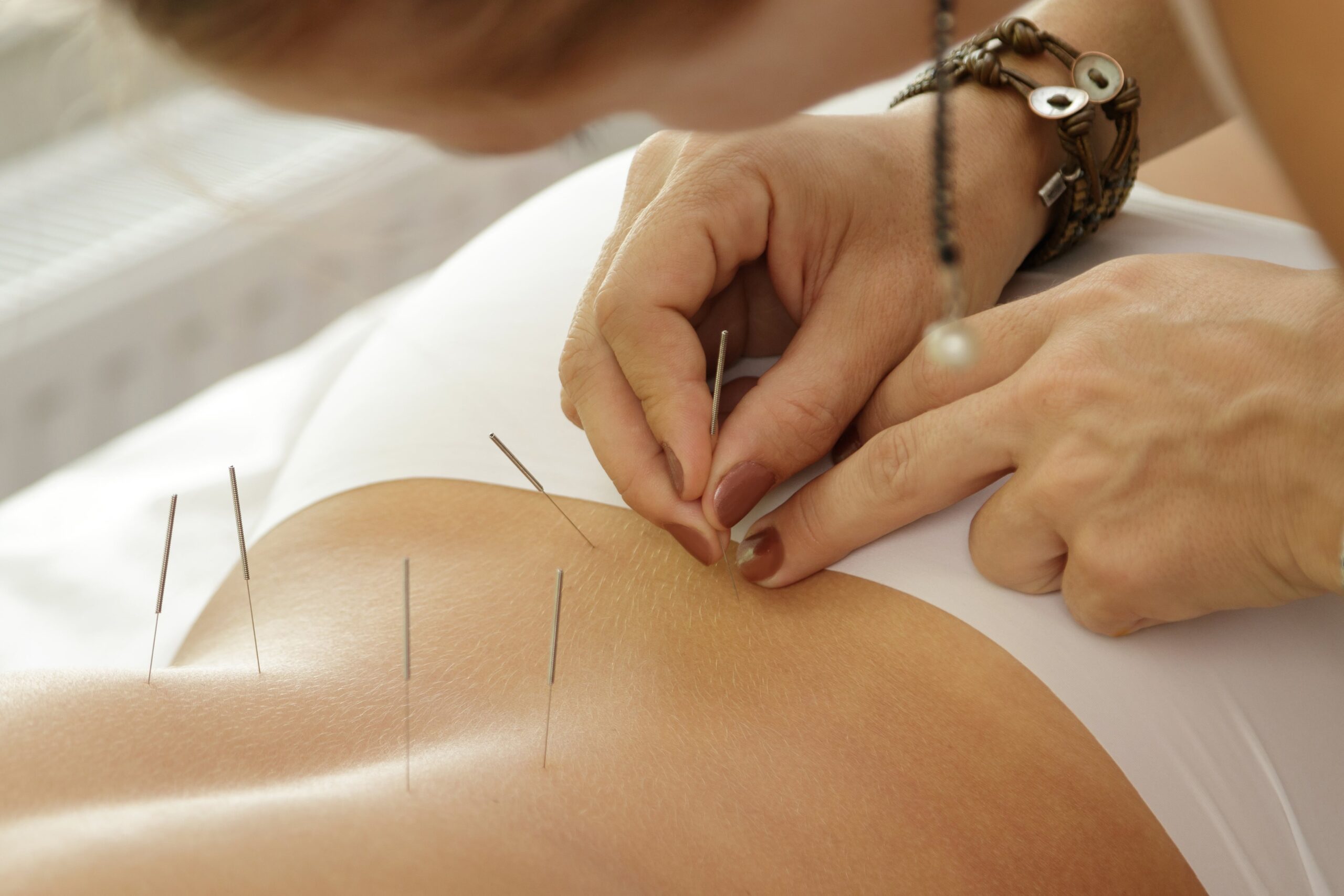 calming-acupuncture-photos