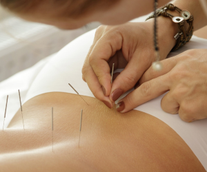 Acupuncture Brisbane