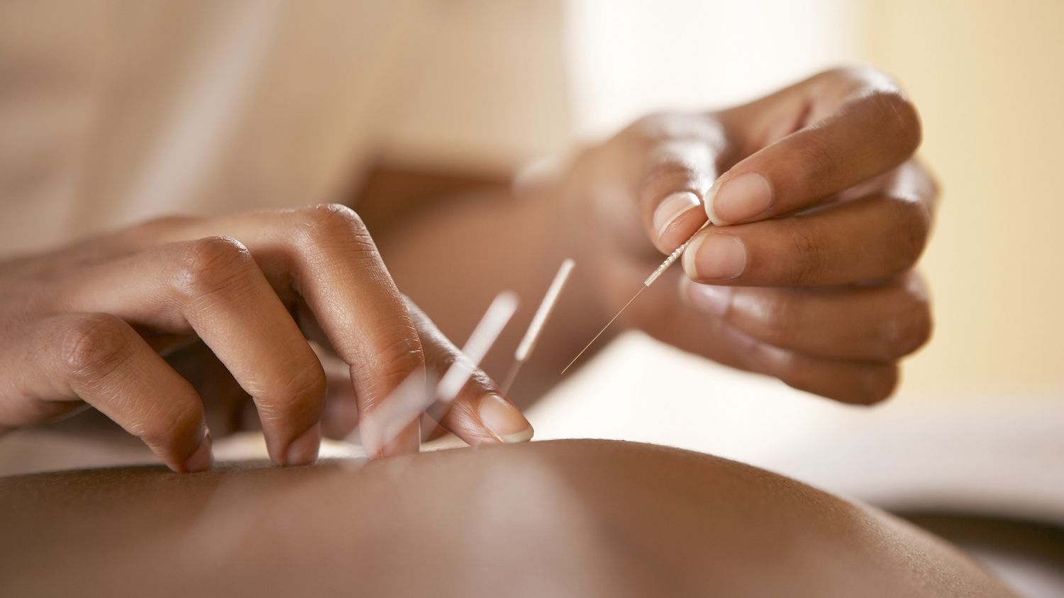 close-up-therapist-doing-acupuncture